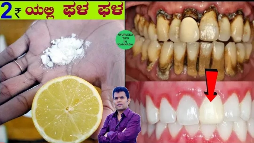 ಈ ಎರಡು ವಸ್ತುಗಳನ್ನು ಉಪಯೋಗಿಸಿದ್ರೆ ಸಾಕು ನಿಮ್ಮ ಹಲ್ಲುಗಳು ವಜ್ರದಂತೆ ಹೊಳೆಯುತ್ತವೆ. ಎಷ್ಟೇ ಕಲೆ ಇರಲಿ ನಿಮಿಷದಲ್ಲಿ ಮಾಯವಾಗುತ್ತೆ.